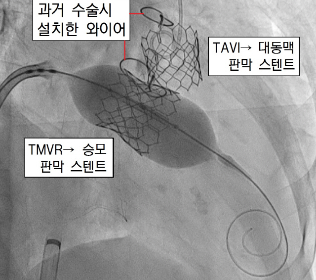 대퇴동맥을 통해 인공 대동맥판막 스텐트를 삽입·고정하는 시술(TAVI) 직후 대퇴정맥→우심방→심방중격(좌우 심방 사이의 벽)에 뚫은 구멍으로 접힌 상태의 인공 승모판막 스텐트를 밀어넣은 뒤 우산처럼 펼쳐 고정하는 시술(TMVR) 과정을 찍은 X선 영상. 스텐트 주변에 있는 2개의 타원형 물체는 10년 전 수술 때 절개했던 가슴뼈를 봉합하기 위해 묶어준 와이어다. /사진제공=서울성모병원