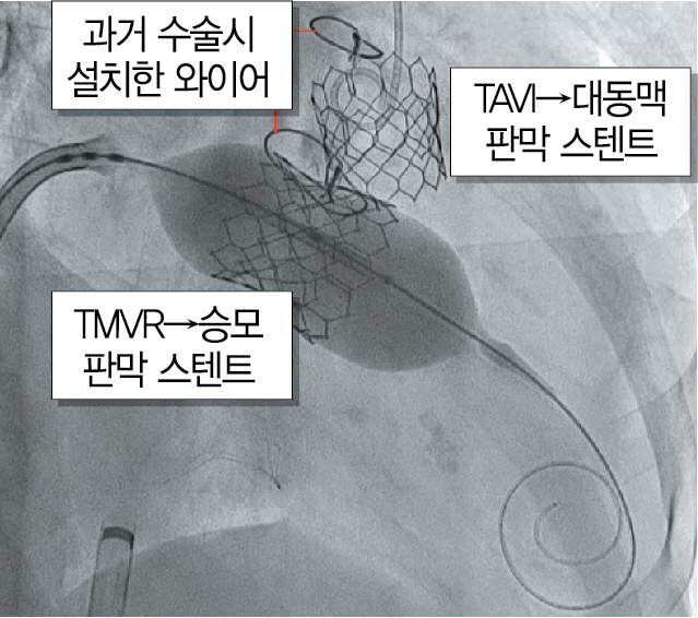 대퇴동맥을 통해 인공 대동맥판막 스텐트를 삽입·고정하는 시술(TAVI) 직후 대퇴정맥→우심방→심방중격(좌우 심방 사이의 벽)에 뚫은 구멍으로 접힌 상태의 인공 승모판막 스텐트를 밀어넣은 뒤 우산처럼 펼쳐 고정하는 시술(TMVR) 과정을 찍은 X선 영상. 스텐트 주변에 있는 2개의 타원형 물체는 10년 전 수술 때 절개했던 가슴뼈를 봉합하기 위해 묶어준 와이어다. /사진제공=서울성모병원