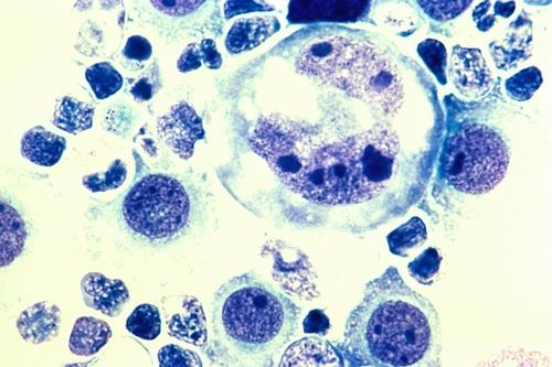 암세포는 “동면”때문에 화학 요법을 피합니다 … 암 치료에 대한 중요한 증거가 있습니까?