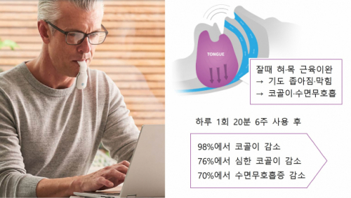 ‘익사이트OSA’는 깨어 있을 때 혀에 끼워 물고 있으면 전기자극을 통해 혀 근육의 기능을 개선, 코골이와 수면무호흡증을 완화·치료하는 의료기기다. /사진=익사이트OSA 홈페이지