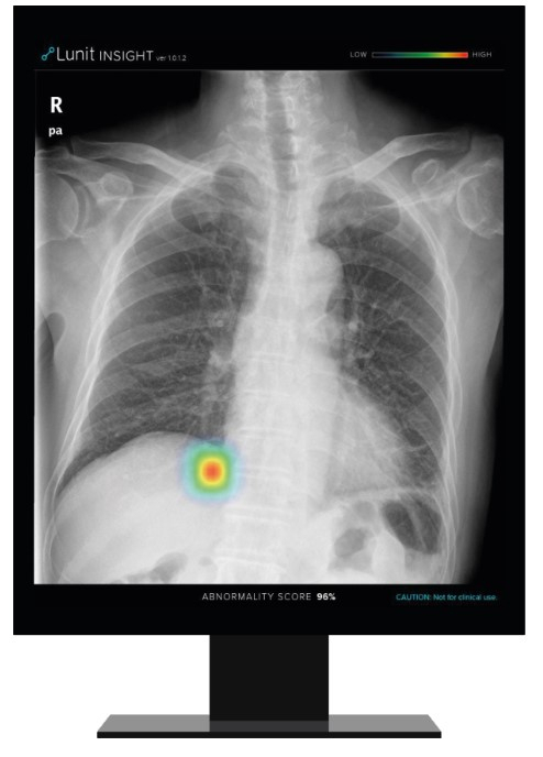 루닛의 폐 질환 진단 보조 소프트웨어 '루닛 인사이트 CXR'./사진제공=루닛