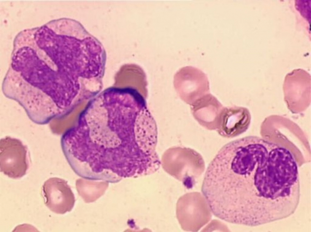 비정상적인 백혈구만 폭발적으로 증가한 급성 백혈병 환자의 혈액세포 현미경 사진.
