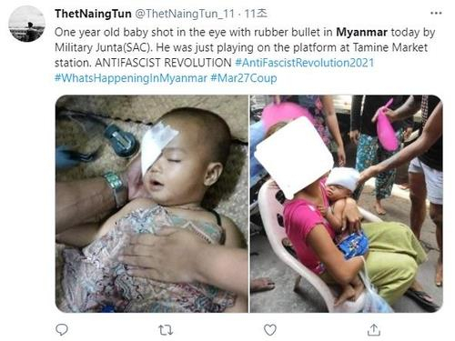 미얀마 군경의 총격으로 인해 양곤 교외의 집 근처에서 놀던 한 살배기 여자 아이가 눈에 고무탄을 맞은 사진이 소셜미디어에 퍼졌다. /연합뉴스=트위터캡처