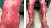 얀센 코로나19 백신을 맞고 부어오름과 가려움증 증상이 나타난 리처드 테럴의 팔과 다리./출처=트위터