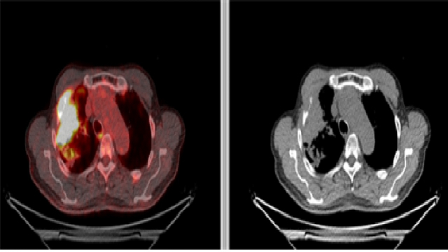 폐암 환자의 양전자방출단층촬영(PET), 전산화단층촬영(CT) 사진. 왼쪽 PET 사진에서 밝게 보이는 부분이 폐암이며, 진행된 폐암이 흉벽과 늑골에 넓게 침범한 것을 확인할 수 있다. /사진제공=서울아산병원