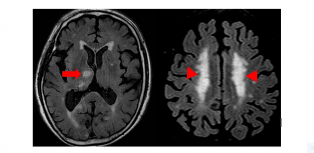 혈관성 치매 환자의 뇌 사진. 주요 부위의 뇌경색(큰 화살표) 및 광범위한 백질변성(작은 화살표)을 보이고 있다. /사진제공=서울아산병원