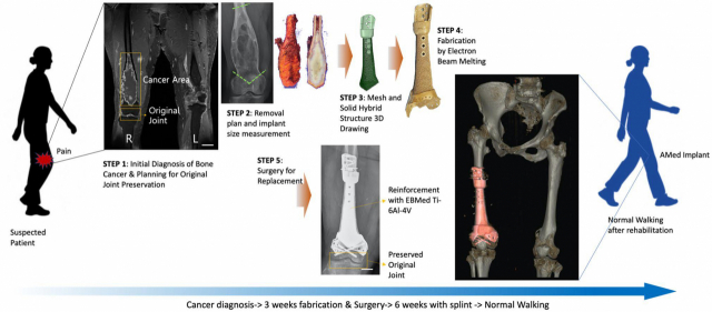 3D 프린팅 임플란트를 이용한 골종양 치료 진행과정. /그림=UNIST