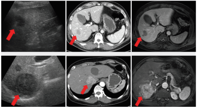 화살표 끝이 가리키는 부위에 간암의 종괴가 확인된다. 위 아래 묶음으로 왼쪽부터 초음파, 컴퓨터단층촬영(CT), 자기공명영상(MRI) 사진. /사진 제공=삼성서울병원
