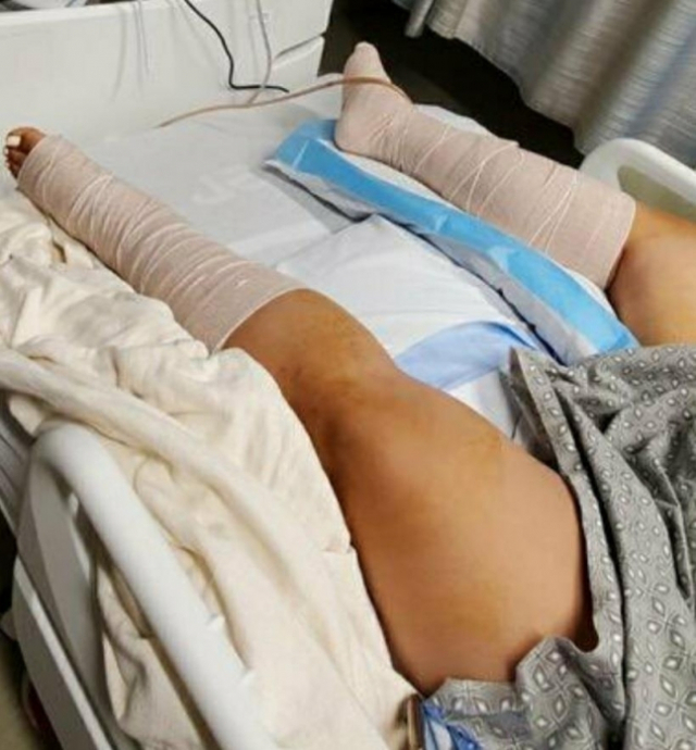 험멜은 다리 근육과 신경 조직이 손상돼 현재는 걷지 못하는 상태다./미국 abc7 기자 리즈 크로츠 트위터 캡처