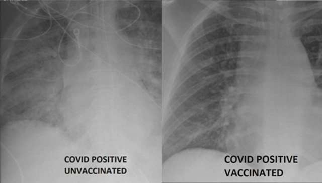백신을 맞지않고 코로나19에 감염된 환자의 폐 사진(왼쪽)과 돌파감염 된 환자의 폐 사진. /KDSK 홈페이지 캡처