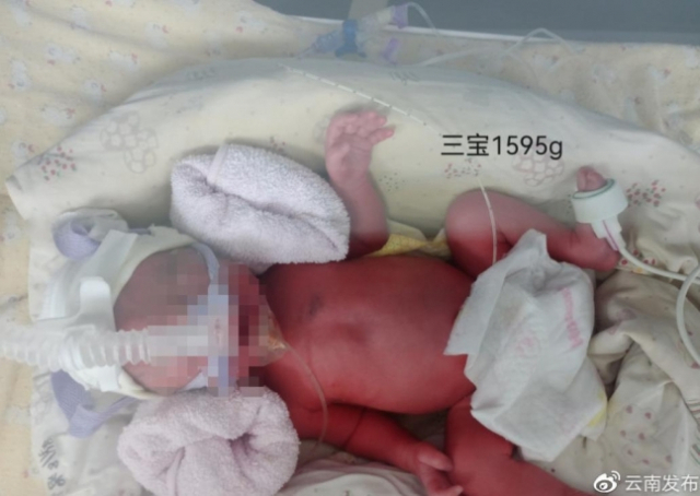 중국서 코로나19에 걸린 임산부가 세쌍둥이를 무사히 출산했다./윈난성 정부 웨이보 캡처