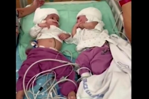머리가 붙은 채 태어난 이스라엘 샴쌍둥이의 분리 수술이 성공적으로 진행된 이후 쌍둥이가 서로를 마주 보고 있다. /로이터연합뉴스