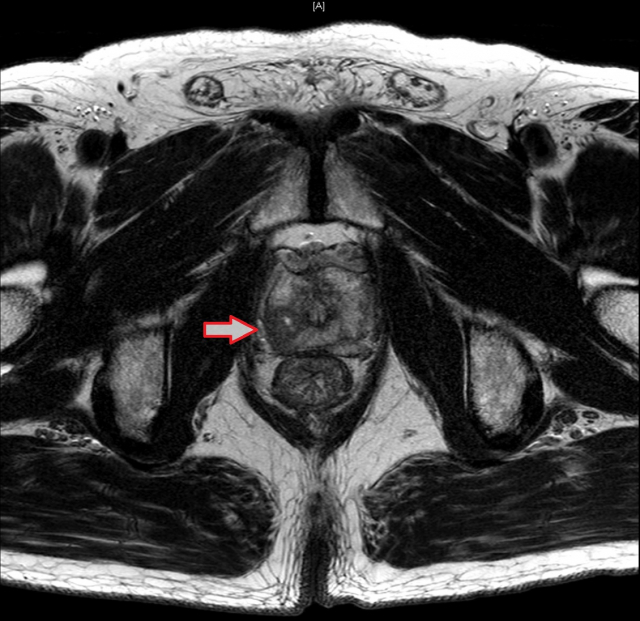 한 환자의 전립선 MRI 영상에서 전립선 우측 전립선암(화살표)이 보이고, 전립선 피막의 침범이 의심된다./사진 제공=삼성서울병원