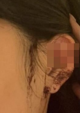 '술 깨보니 귀 잘려'…강남 클럽서 피흘린채 발견된 20대 여성