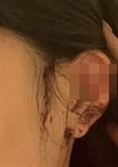 "술 깨보니 귀 잘려"…강남 클럽서 피흘린채 발견된 20대 여성