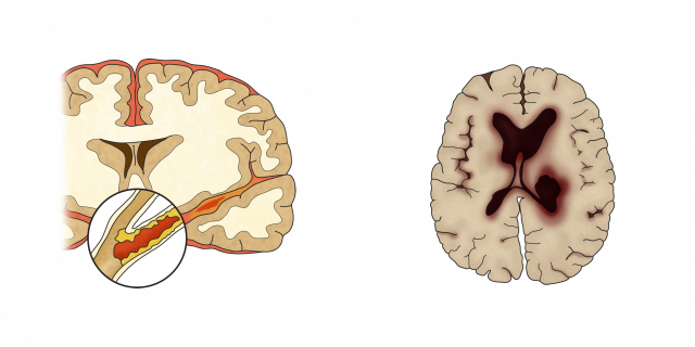 혈관이 막혀 뇌가 손상되면 ‘뇌경색’(왼쪽), 혈관이 터져 뇌가 손상되면 ‘뇌출혈’로 분류된다./사진 제공=서울아산병원