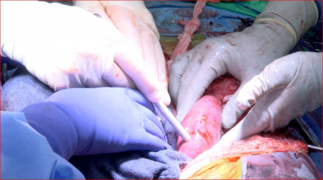 미 앨라배마주 버밍엄대 의료진이 뇌사자의 체내에 유전자조작 돼지의 신장을 이식하는 수술을 진행하고 있다./AFP연합뉴스