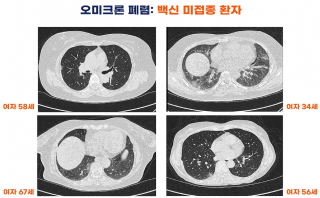 오미크론 환자의 폐 CT 결과. 사진 제공=서울대병원