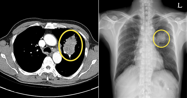 폐암 환자의 CT 검사(왼쪽)와 엑스레이 검사 사진. 사진 제공=서울아산병원