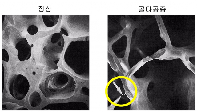 정상인과 골다공증 환자의 뼈 단면 비교사진. 사진 제공=대동병원