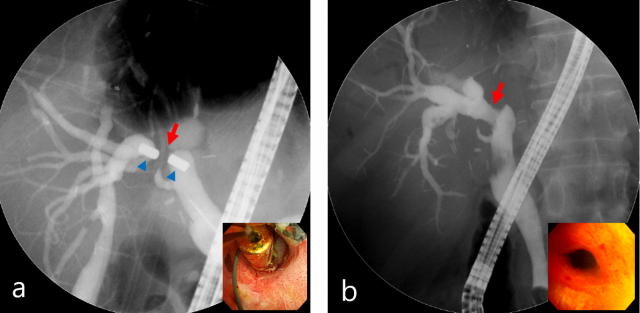 담즙관 협착 환자에게 적용하는 자기압축문합술 과정을 보여주는 담관 엑스레이(왼쪽) 및 내시경 사진. 사진 제공=강남세브란스병원