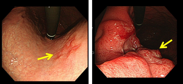 조기 위암(왼쪽)과 진행성 위암의 내시경 사진. 사진 제공=서울아산병원