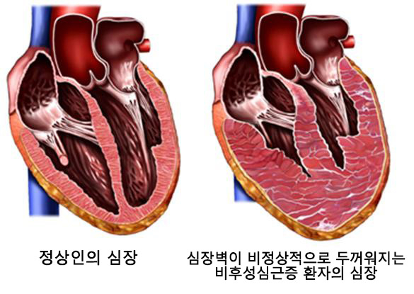 비후성심근증 모식도. 사진 제공=서울대병원