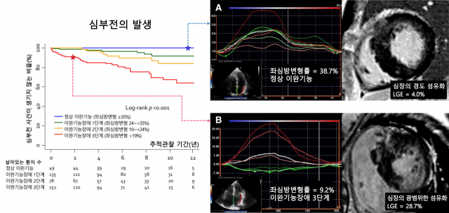 심부전 관련 무사건 생존율 그래프(왼쪽)와 환자 사례. 사진 제공=서울대병원