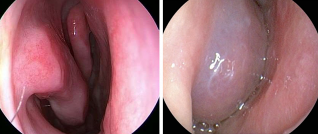 정상(왼쪽)과 알레르기 비염 환자의 코 점막 사진. 사진 제공=서울아산병원