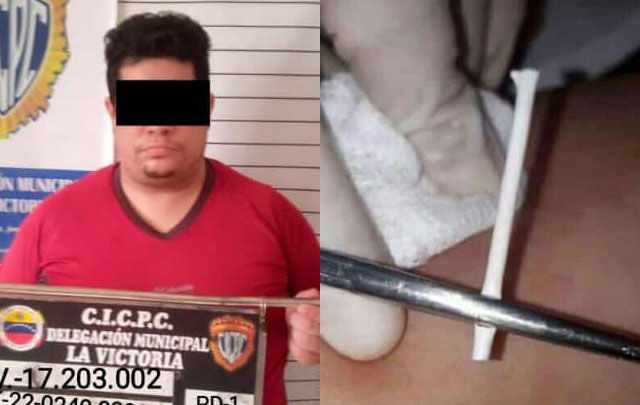 베네수엘라에서 피임기구 대신 사탕막대를 이식한 가짜 의사가 체포됐다. 트위터