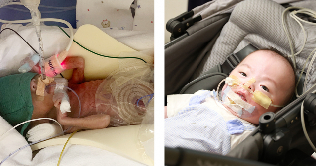 초극소 미숙아로 태어난 하진이의 생후 2주차 모습(왼쪽)과 6Kg으로 건강하게 성장한 하진이의 첫 번째 외래 진료 시 모습. 사진 제공=서울성모병원