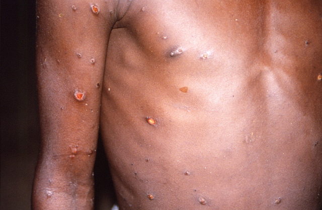 1996~1997년 콩고에서 원숭이두창에 감염된 환자. 로이터연합뉴스
