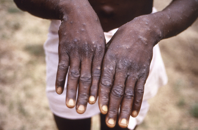 콩고민주공화국에서 1997년 원숭이두창에 걸린 사람의 손. 미 질병통제예방센터(CDC)가 언론에 배포했다. AP연합뉴스