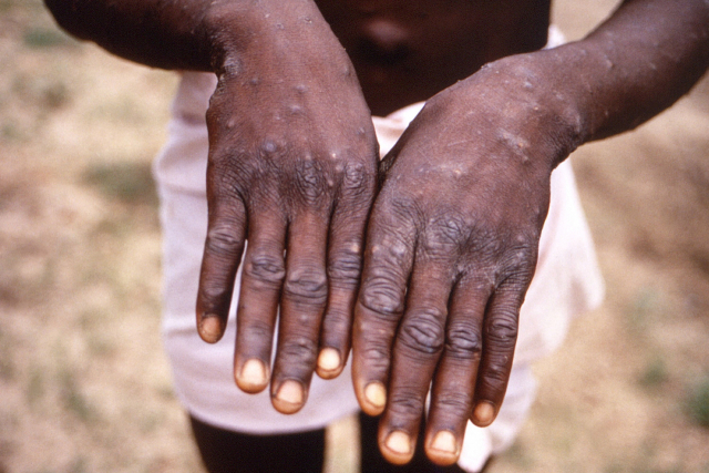 미 질병통제예방센터(CDC)가 언론에 배포한 1997년 콩고민주공화국에서 원숭이두창에 걸린 사람의 손 모습. AP연합뉴스