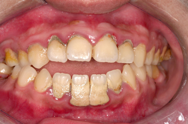 구강관리 어려운 중증 장애 환자, 치료시기 놓치면 치아 손상 악화