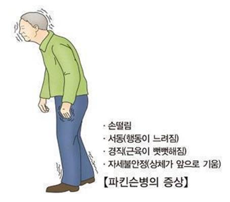 파킨슨병 증상. 서울아산병원 제공