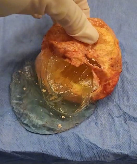 미국의 한 성형외과 의사가 환자의 신체 내부에서 파열된 가슴 보형물을 공개했다. 틱톡 캡처