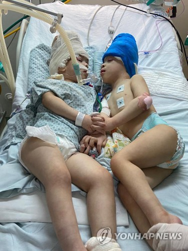 브라질에서 태어난 샴쌍둥이 형제가 성공적인 분리 수술 이후 서로를 마주본 채 잠들어 있다. AFP연합뉴스