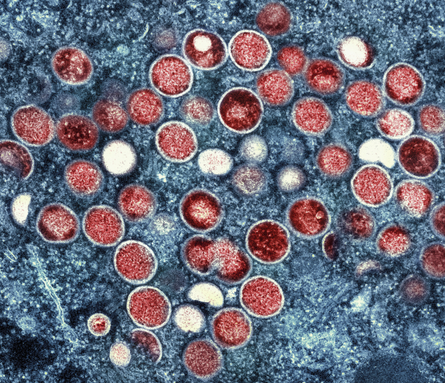 원숭이두창 바이러스 입자(붉은색) 전자현미경 이미지.
