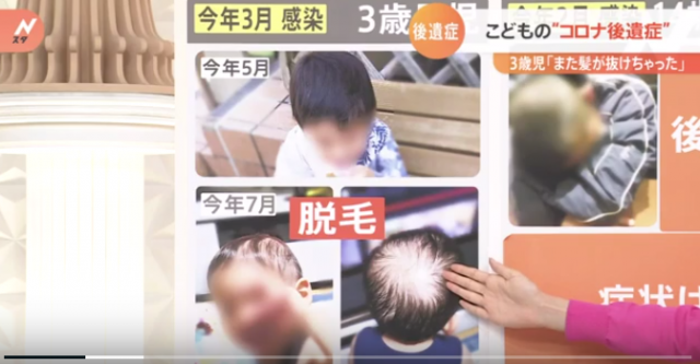 일본에서 한 3세 남자아이가 코로나19 후유증으로 심한 정수리 탈모를 겪고 있다. 일본 TBS 캡처