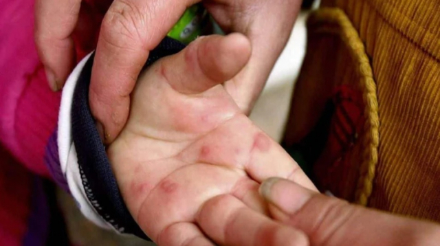 토마토 독감에 걸린 아이의 손. 인디아 투데이 캡처