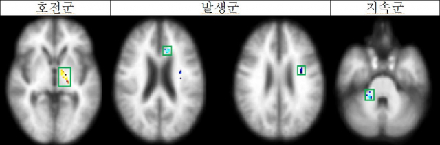 호전군에서는 시각기억 경로의 회복(노란색)을 확인했으며, 발생군과 지속군에서는 시각기억 관련된 부위의 뇌손상(파란색을) 확인할 수 있다. 사진 제공=분당서울대병원