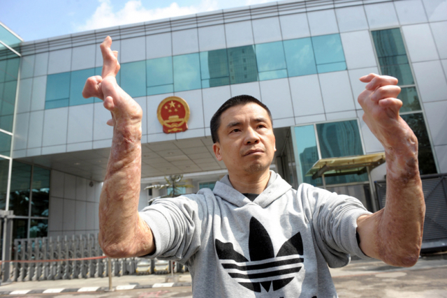 2013년 무죄 판결을 받고 출소하며 자신의 팔과 손의 기형을 공개한 장린펑. 바이두