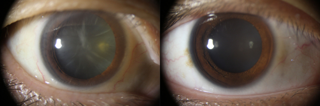 백내장이 있는 눈(왼쪽)과 없는 눈의 안구 사진. 백내장이 있는 눈은 수정체가 변성되어 뿌옇게 보인다. 사진 제공=세브란스병원