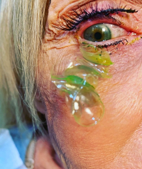 미 캘리포니아주 뉴포트 비치 안과전문의 카테리나 쿠르테바가 70대 중반 여성 환자 눈에서 콘택트렌즈 23개를 제거했다고 밝혔다. 카테리나 쿠르테바 전문의 인스타그램