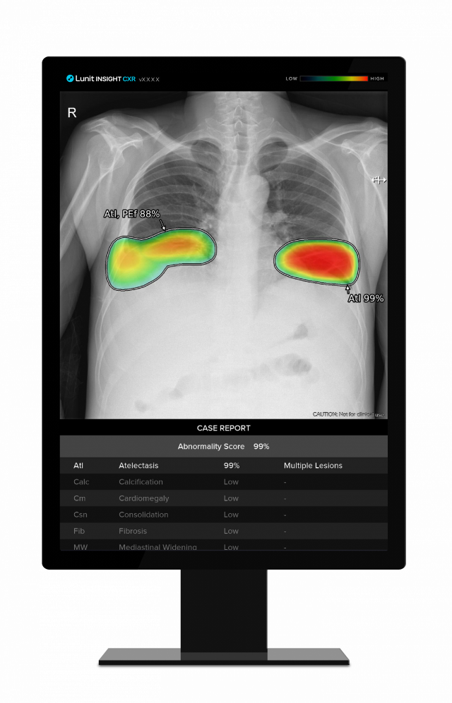 흉부 엑스레이 영상분석 AI 솔루션 '루닛 인사이트 CXR' 활용 이미지. 사진 제공=루닛