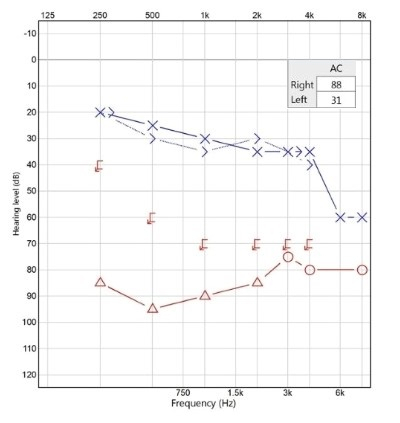 오른쪽 귀에 돌발성 난청 판정을 받은 환자의 청력 측정 그래프. 오른쪽 귀의 청력을 나타내는 그래프(빨간색)가 왼쪽 귀의 청력 그래프(파란색)보다 아래에 있는데, 이는 오른쪽 귀의 청력이 저하됐음을 나타낸다. 사진 제공=세브란스병원