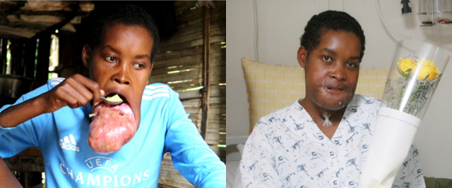 아프리카 남동쪽 섬나라 마다가스카르 오지 지역의 청년 플란지 씨의 수술 전(올해 5월·왼쪽 사진)과 수술 후(오른쪽 사진) 모습. 사진 제공=서울아산병원