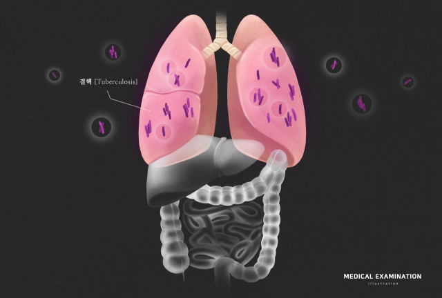 완치되도 안심 못한다…결핵 앓으면 '이 병' 위험 22% 증가[헬시타임]