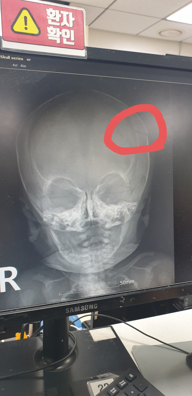 부산의 한 산후조리원에서 발생한 낙상 사고로 두개골이 부러진 아기. 네이트판 갈무리